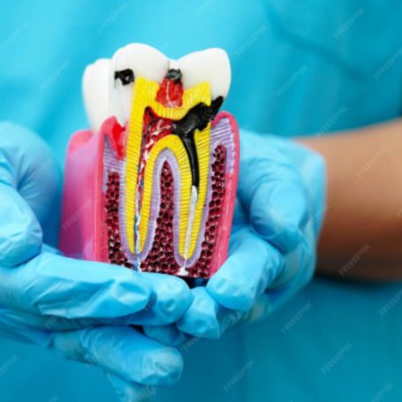 Wisdom teeth removal